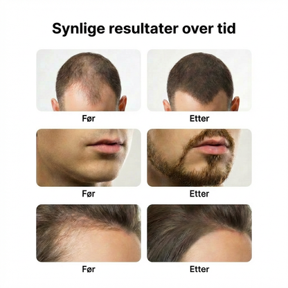 Minoxidil 5% Foam - 6 måneders forbruk